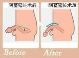 锦州阴茎延长术费用是多少